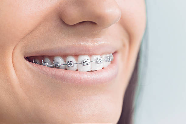 Dental Inlays and Onlays in Bluffton, IN